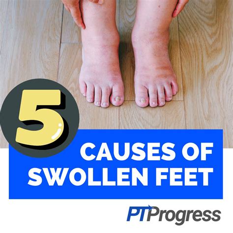 Risk Factors and Complications of Swollen Feet