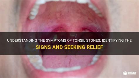 Signs and Symptoms: Identifying Indications of Tonsil Concretions