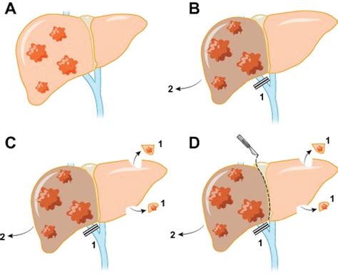 The Captivating History of Surgical Interventions on the Liver