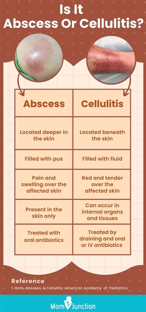 The Factors Behind Abscess Formation