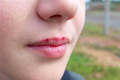 The Hidden Meanings: Deciphering the Messages Concealed Within Lip Bleeding