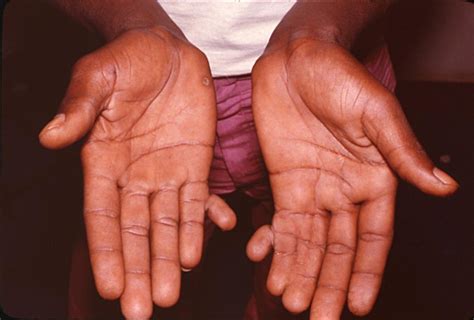 The Historical and Cultural Significance of Polydactyly