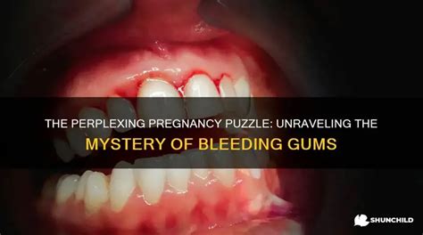 The Mysterious Puzzle of Gum Bleeding in the Realm of Dreams