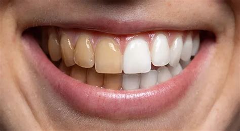 The Potential Risks and Side Effects of Teeth Whitening