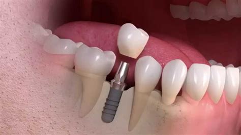 The Procedure: How Does an Implant for a Sparkling Gem Encrusted Tooth Work?