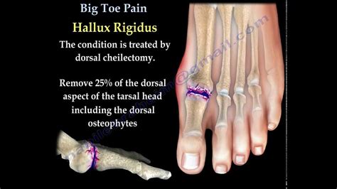 The Relationship Between Footwear and Pain in the Largest Toe