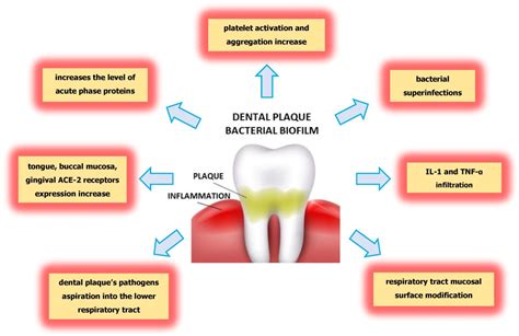 The Role of Plaque in Periodontal Concerns