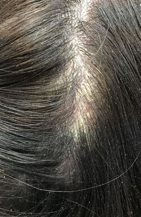 The Roots of Dry Scalp