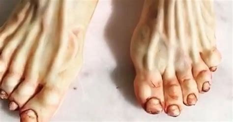 The Significance of Dreaming about Severed Feet