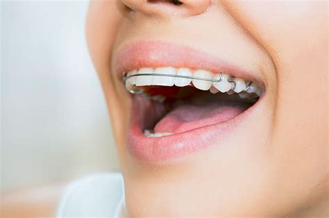 The Significance of Retainers in Attaining an Ideal Smile