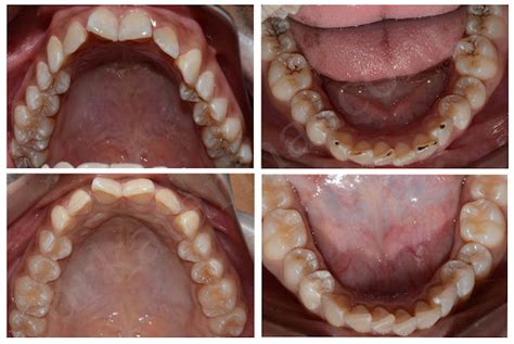 The Significance of a Disturbing Dream Involving a Challenged Infant's Decayed Teeth