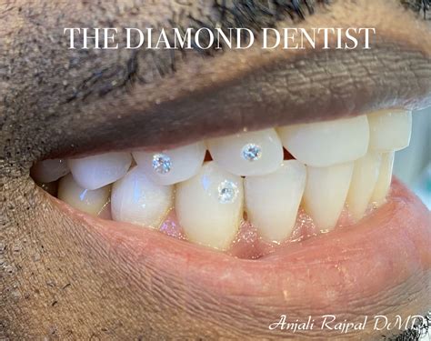 The Soaring Popularity of Diamond Tooth Implants