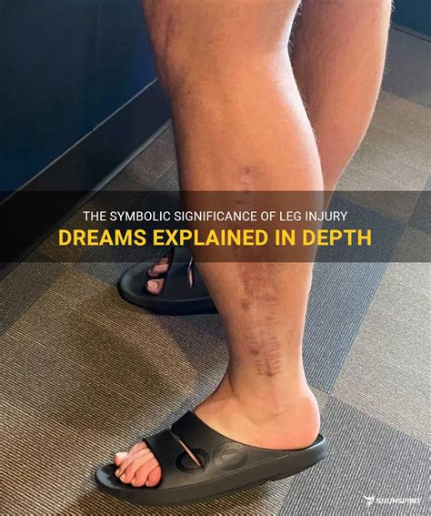 The Symbolic Significance of Dreaming about an Injury to the Foot