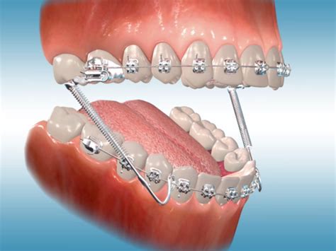 The Symbolism Behind Dreams of Descending Orthodontic Appliances