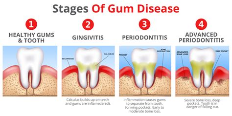 The Underlying Factors Behind Gum Infections