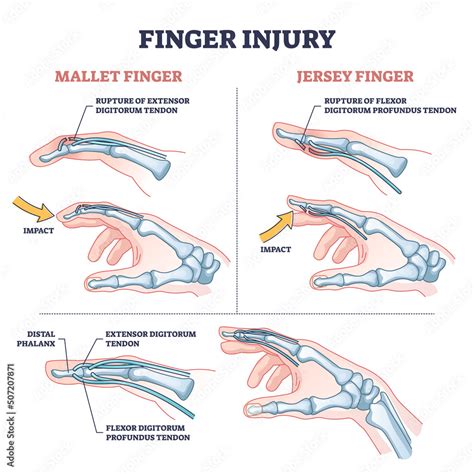 The Varied Explanations Based on the Extent of Injury to the Hand