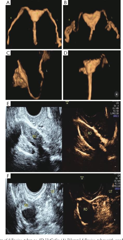 The Vital Role of Sonography in Assisted Reproductive Technologies