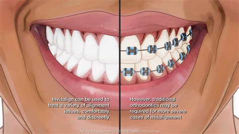 Tips and Strategies for Unraveling the Significance of Your Braces Nightmares