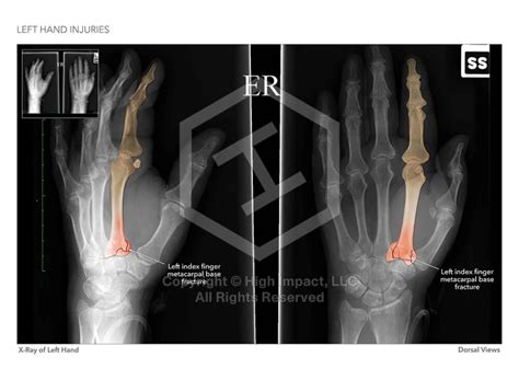 Tips for Analyzing and Interpreting Dreams of Left Hand Injuries