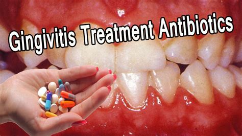 Treatment Options for Gum Infections