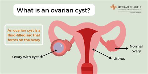 Treatment Options for Ovarian Cysts: From Medication to Surgery