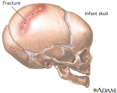 Uncovering possible cultural and historical significances of a fractured cranium in visions