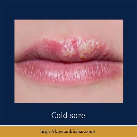 Understanding Cold Sores: Causes, Symptoms, and Triggers