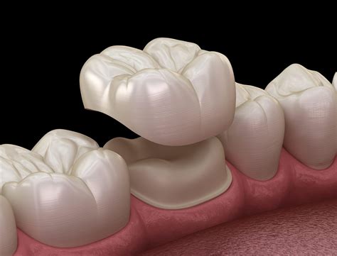 Understanding Dental Crowns: What You Should Know