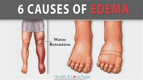 Understanding Edema: The Science behind Fluid Retention in Lower Limbs