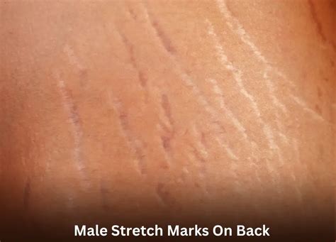 Understanding Stretch Marks: Causes and Appearance