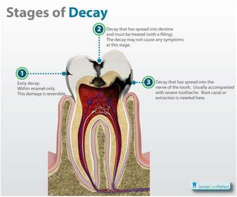 Understanding and Decoding the Meaning of Dreams featuring Decayed Dental Structure