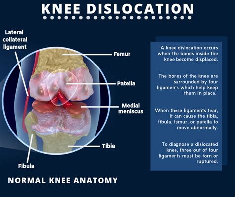 Understanding the Dislocated Knee: Anatomy and Mechanism of Injury