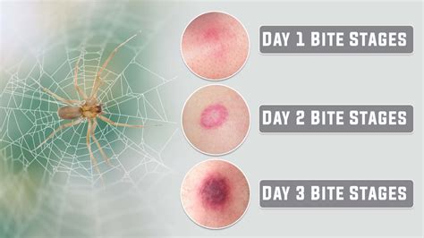 Understanding the Immediate Impacts of Spider Bites