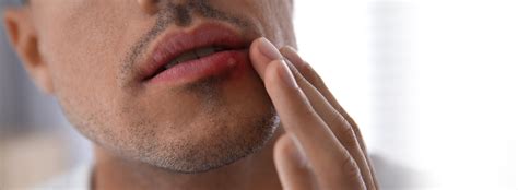 Understanding the Origins of Oral Herpes Outbreaks