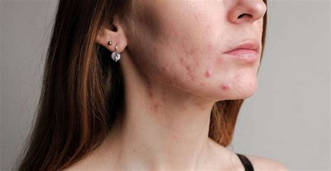 Understanding the Psychology behind Dreams related to Acne