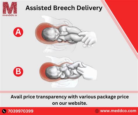 Understanding the Significance of Dreams Involving Breech Deliveries