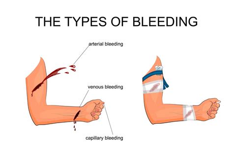 Understanding the Significance of Leg Bleeding in Different Cultural Interpretations