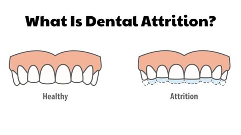 Understanding the Symbolism: How Dreaming of Dental Attrition Reflects Personal Anxiety and Insecurity