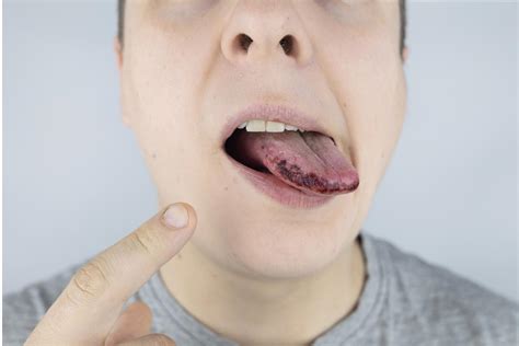 Understanding the common causes of dark spots on the tongue