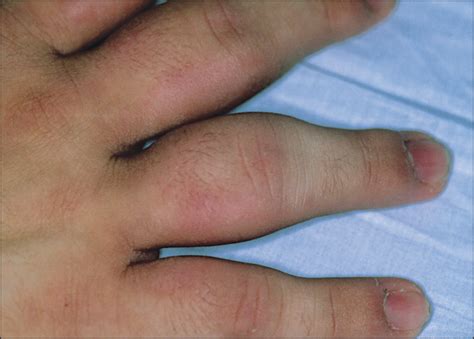 Understanding the intricacies of thumb infections: A comprehensive guide