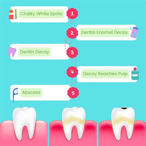 Unlocking the Enigma of Tooth Decay: Essential Insights