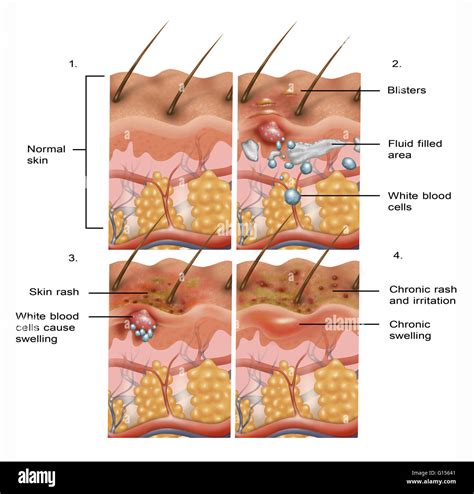 Unlocking the Enigmatic Origins of Surging Skin Blisters