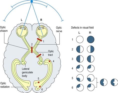 Unlocking the Potential Triggers Behind Enigmatic Vision Disturbances