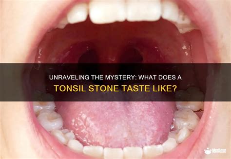 Unraveling the Mystery: What Exactly are Tonsilloliths?