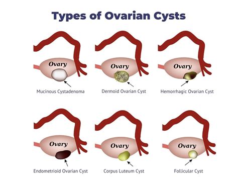 Unveiling the Culprits: Common Causes of Ovarian Cysts