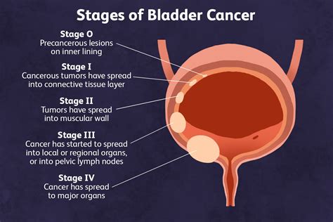 What Can Experiencing Bladder Cancer in Your Dreams Reveal About Your Emotional Well-being?