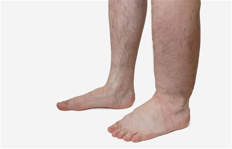 When Swollen Legs Are More Than Meets the Eye: Underlying Medical Conditions