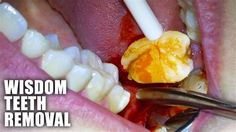 Wisdom Tooth Extraction: Make Your Choice with Confidence